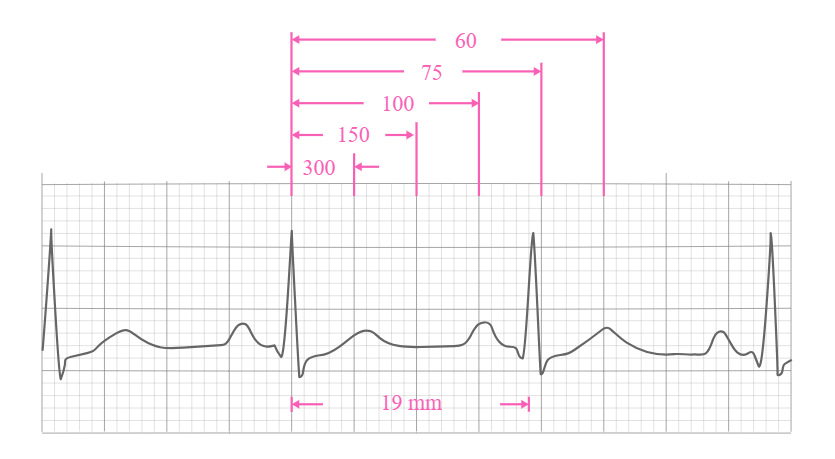 ECG 300 Rule Calculation Example